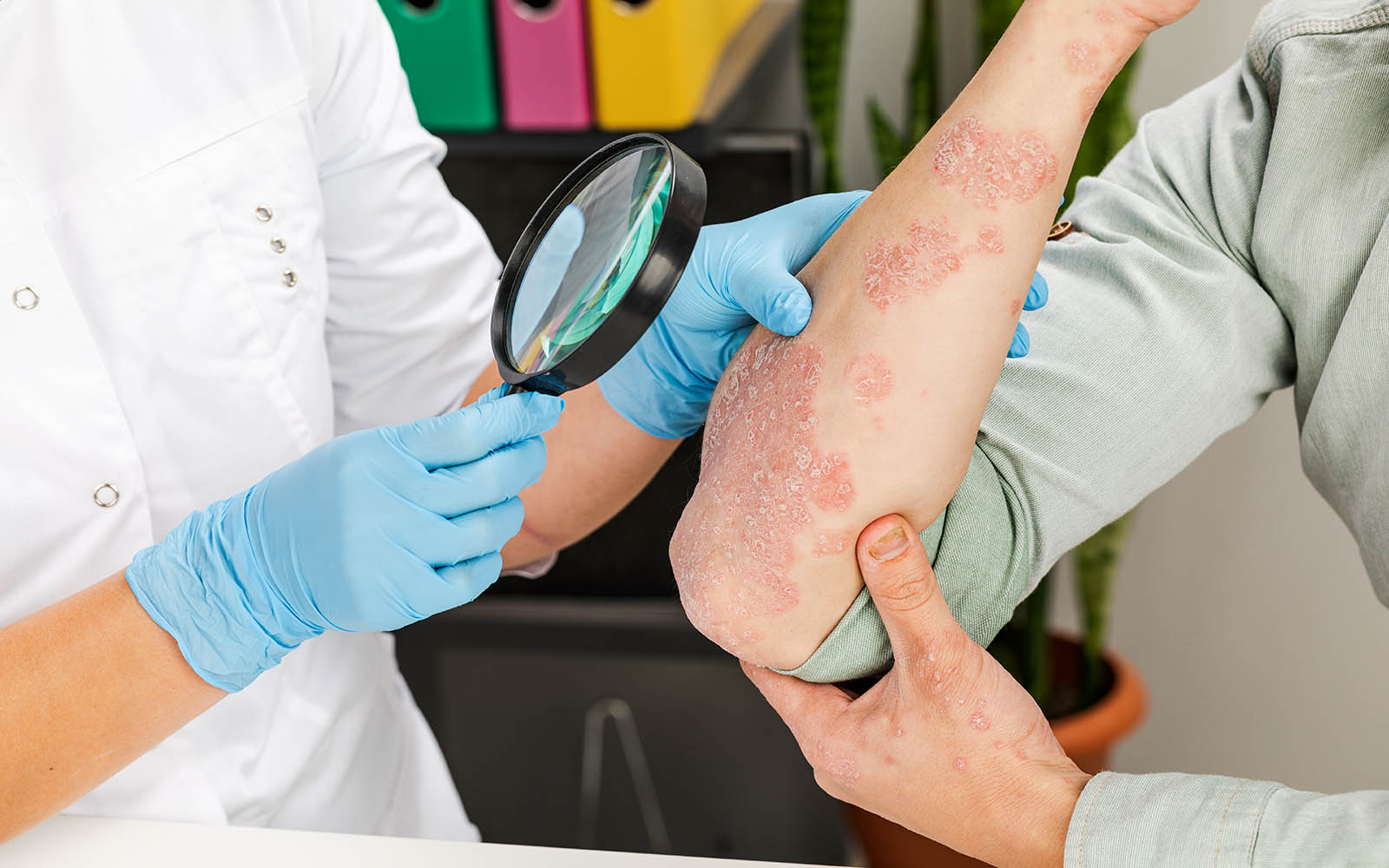 Psoriasis: Ursachen und Therapie